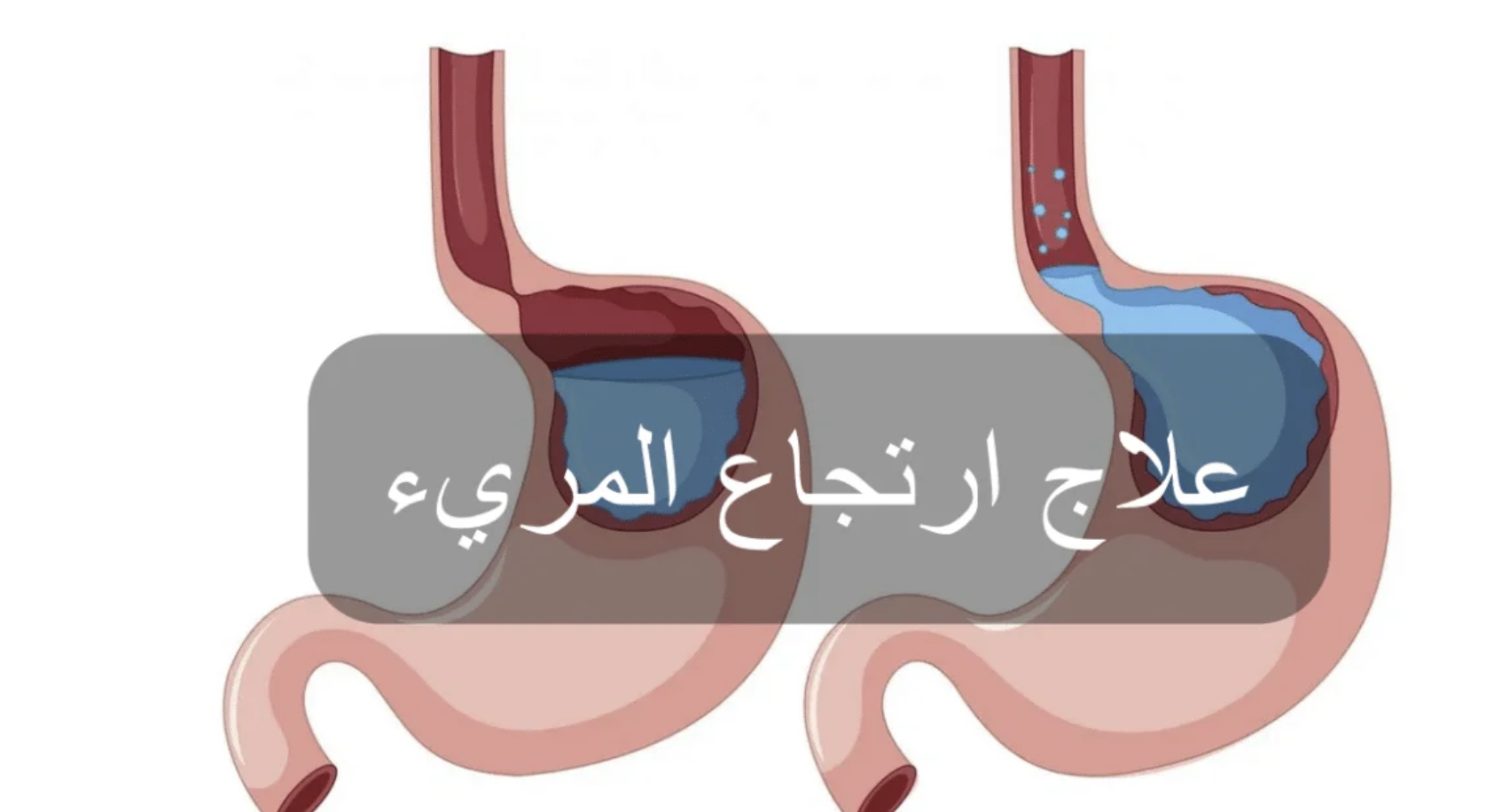 علاج ارتجاع المرئ